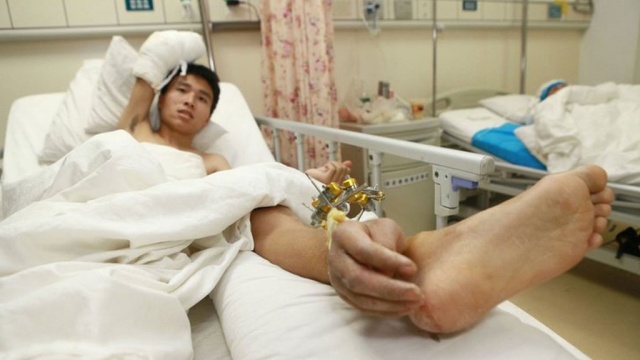 Китайские врачи пересадили отрезанную руку на ногу пациента